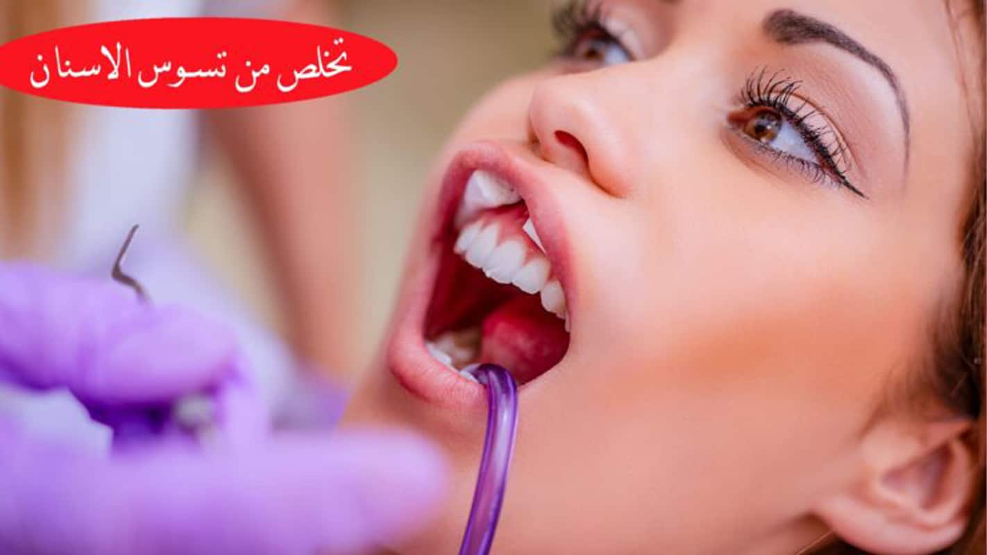 علاج تسوس الاسنان2022