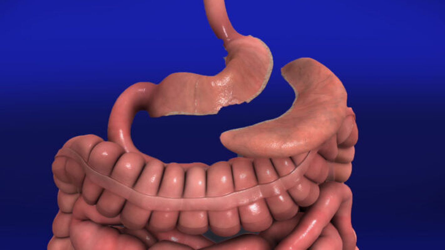 عملية تكميم المعدة في تركيا إنقاص الوزن في زمن قياسي 2 ما هي تكميم المعدة
