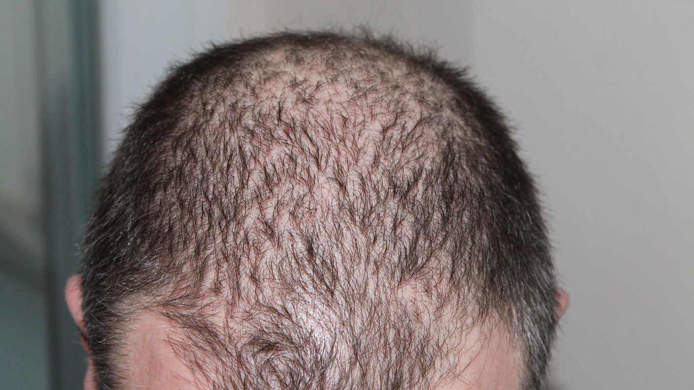 اسباب تساقط الشعر الوراثية