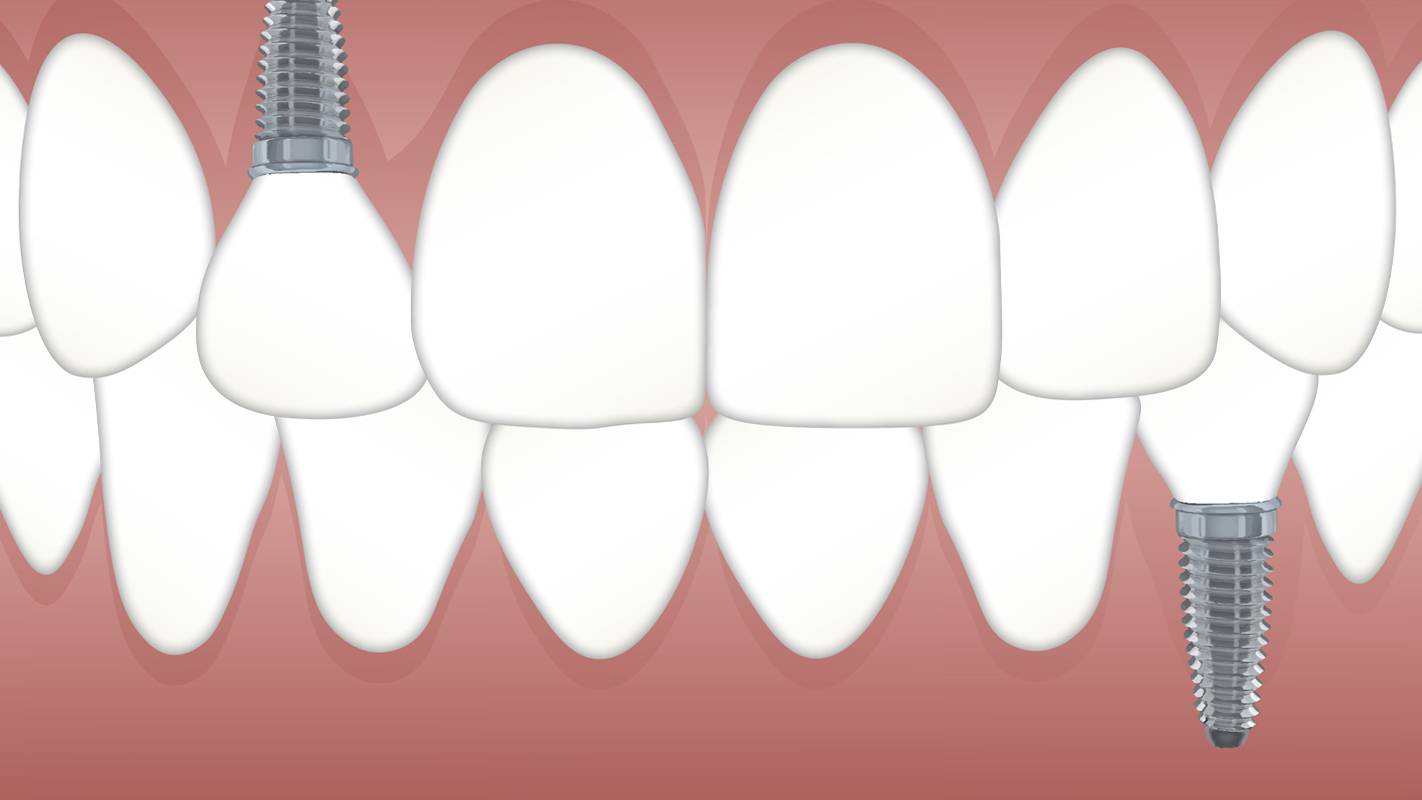 مرحلة الشفاء عند زرع الاسنان