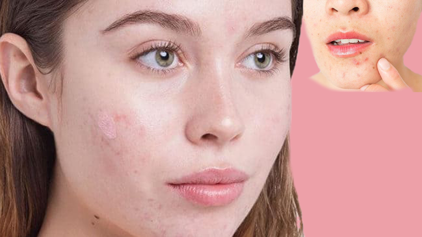 علاج حب الشباب/دليلك الطبي