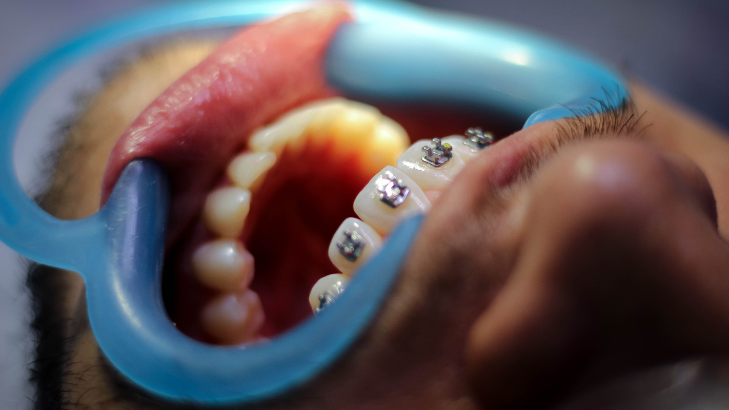 كم جلسة تركيب تقويم الاسنان؟