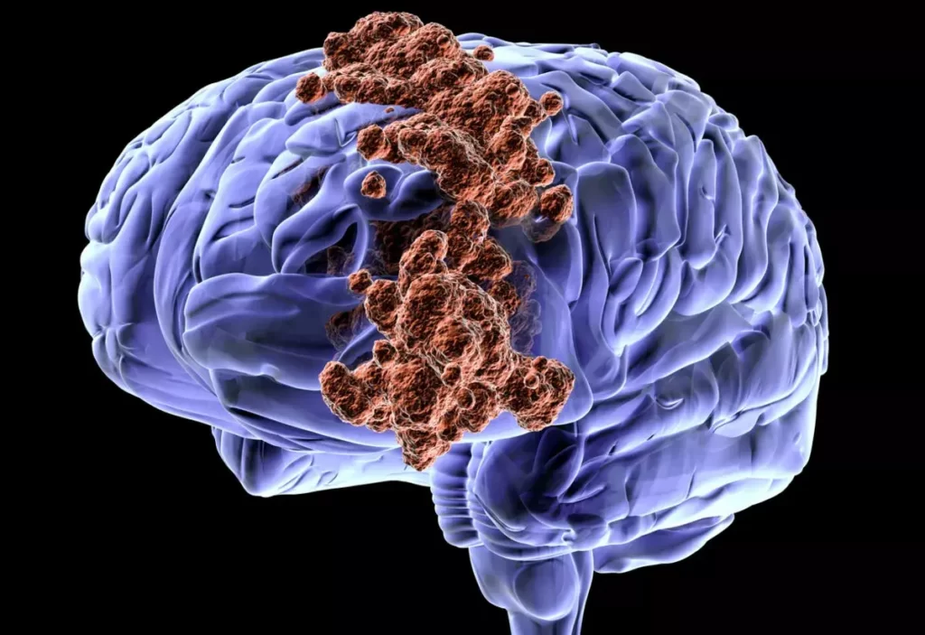 كم يعيش مريض سرطان الدماغ؟
