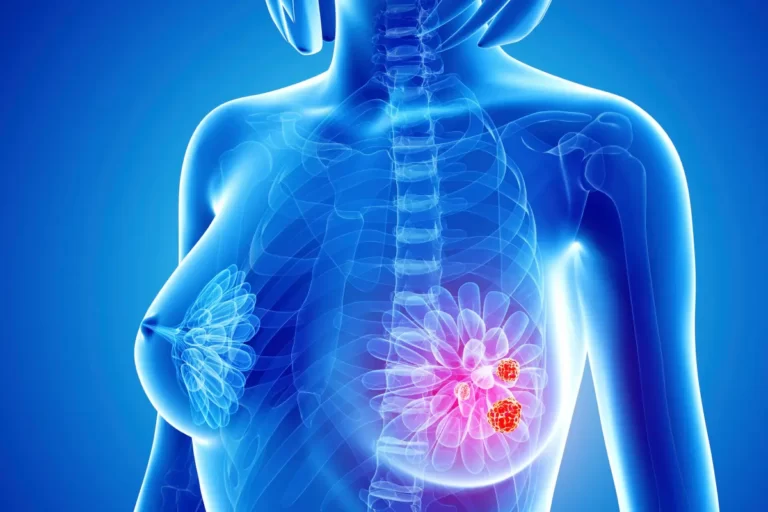 عراض سرطان الثدي الحميد