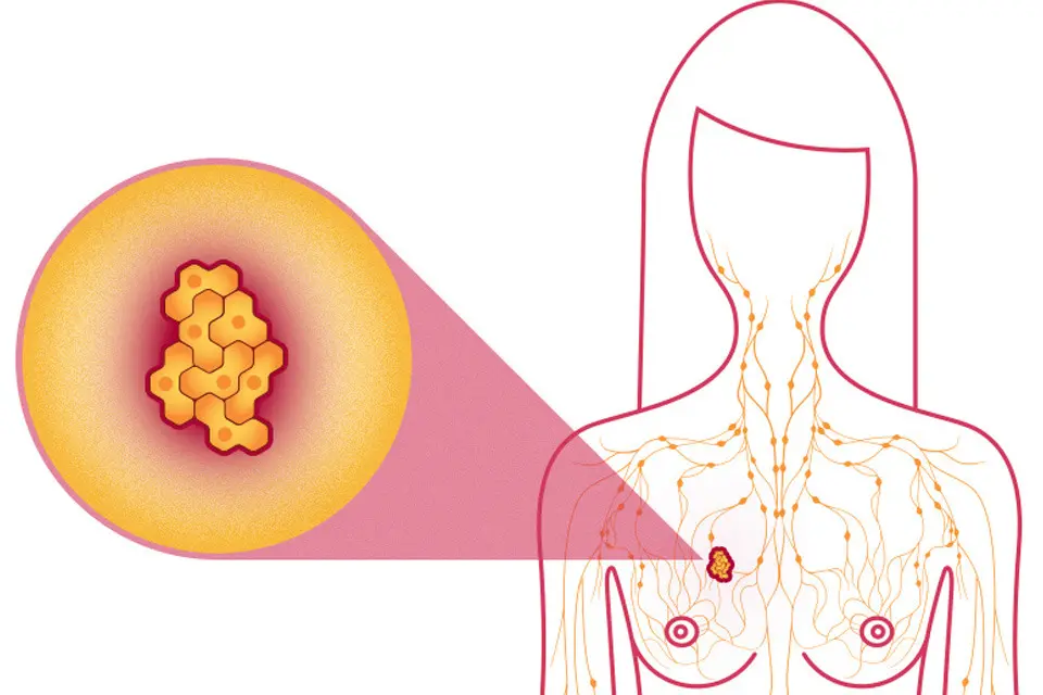كيف تحدث الأورام الحميدة في الثدي؟