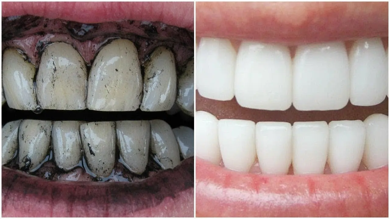 سبع طرق منتظمة لتفتيح وتبييض الأسنان
