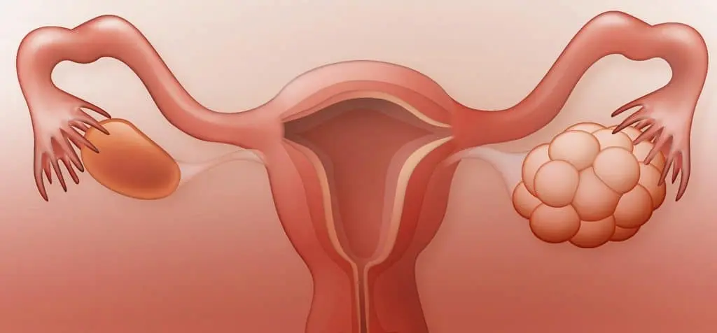 اعراض تكيس المبايض : تعرفي على أهمها 2 اعراض تكيس المبايض