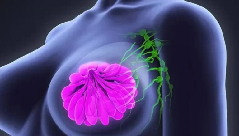 أسباب سرطان الثدي و4 طرق للوقاية